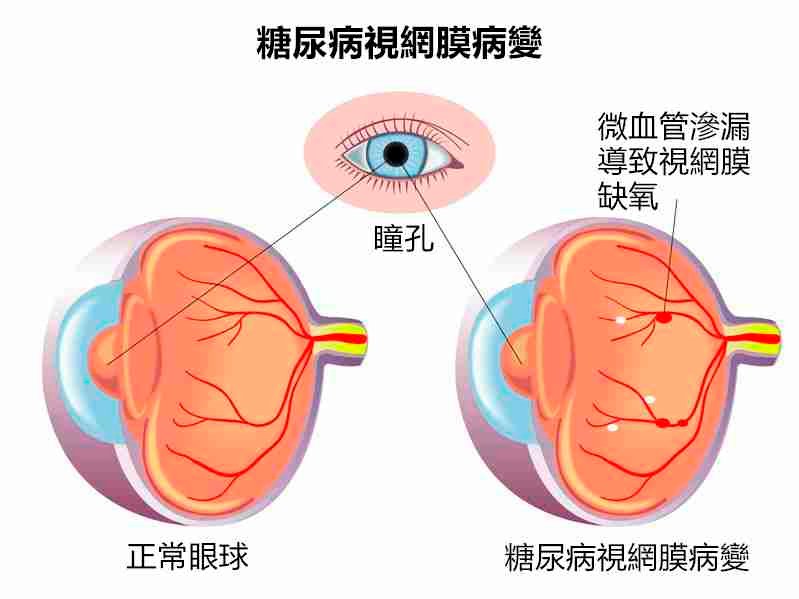 14017840 diabetic retinopathy