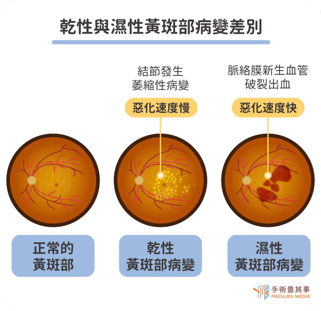 Macular degeneration 04